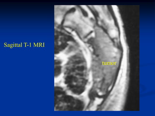 Sagittal T-1 MRI


                   tumor
 