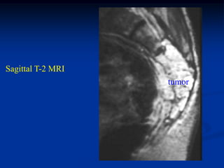 Sagittal T-2 MRI
                   tumor
 