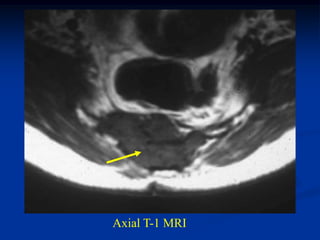 Axial T-1 MRI
 