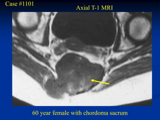 Case #1101
                         Axial T-1 MRI




         60 year female with chordoma sacrum
 