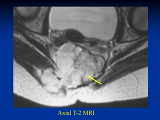 Axial T-2 MRI
 