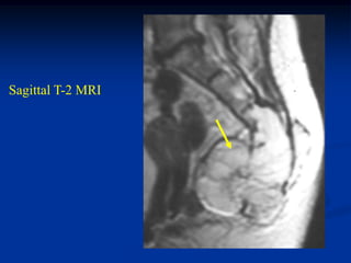 Sagittal T-2 MRI
 