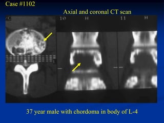 Case #1102
                    Axial and coronal CT scan




       37 year male with chordoma in body of L-4
 