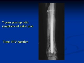 7 years post op with
symptoms of ankle pain



Turns HIV positive
 