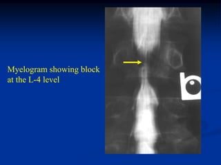 Myelogram showing block
at the L-4 level
 