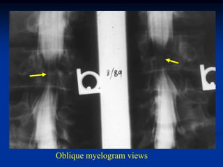 Oblique myelogram views
 