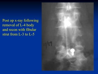 Post op x-ray following
removal of L-4 body
and recon with fibular
strut from L-3 to L-5
 