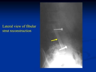 Lateral view of fibular
strut reconstruction
 
