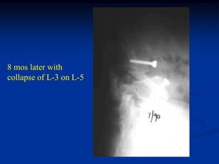 8 mos later with
collapse of L-3 on L-5
 