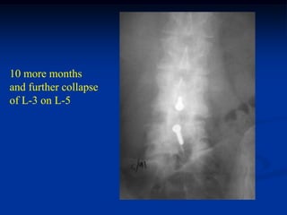 10 more months
and further collapse
of L-3 on L-5
 