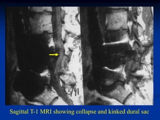 Sagittal T-1 MRI showing collapse and kinked dural sac
 