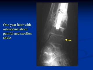 One year later with
osteopenia about
painful and swollen
ankle
 