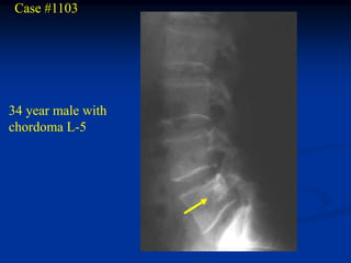 Case #1103




34 year male with
chordoma L-5
 