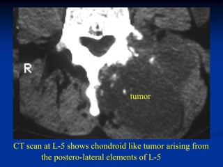 tumor




CT scan at L-5 shows chondroid like tumor arising from
       the postero-lateral elements of L-5
 
