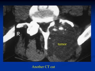 tumor




Another CT cut
 
