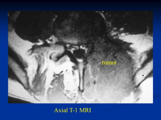 tumor




Axial T-1 MRI
 