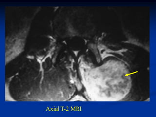 Axial T-2 MRI
 