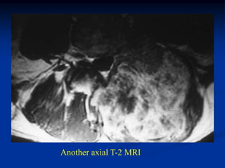 Another axial T-2 MRI
 