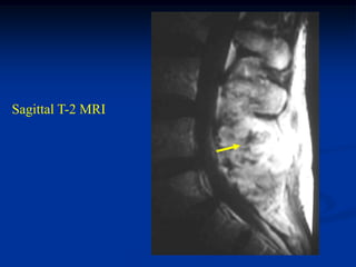 Sagittal T-2 MRI
 