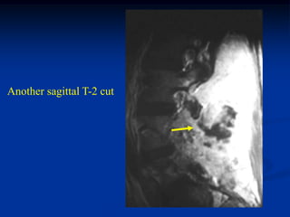 Another sagittal T-2 cut
 