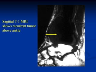 Sagittal T-1 MRI
shows recurrent tumor
above ankle
 
