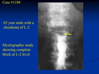 Case #1104




65 year male with a
chordoma of L-2



Myelographic study
showing complete
block at L-2 level
 