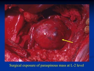 Surgical exposure of paraspinous mass at L-2 level
 