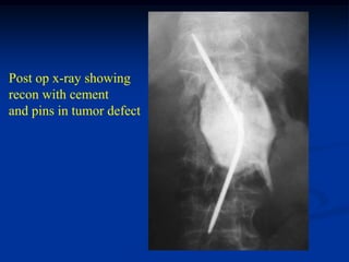 Post op x-ray showing
recon with cement
and pins in tumor defect
 