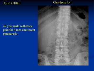 Case #1104.1                Chordoma L-1




49 year male with back
pain for 6 mos and recent
paraparesis
 