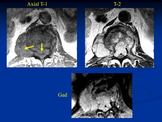 Axial T-1         T-2




            Gad
 