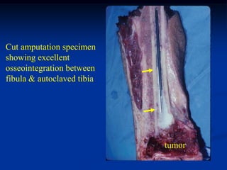 Cut amputation specimen
showing excellent
osseointegration between
fibula & autoclaved tibia




                            tumor
 