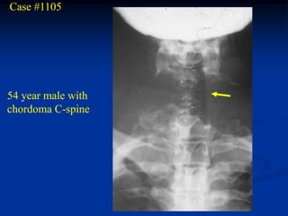 Case #1105




54 year male with
chordoma C-spine
 
