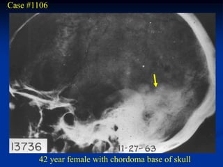 Case #1106




       42 year female with chordoma base of skull
 