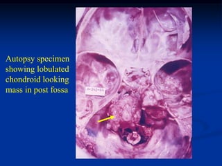 Autopsy specimen
showing lobulated
chondroid looking
mass in post fossa
 