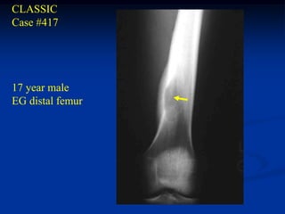 CLASSIC
Case #417




17 year male
EG distal femur
 