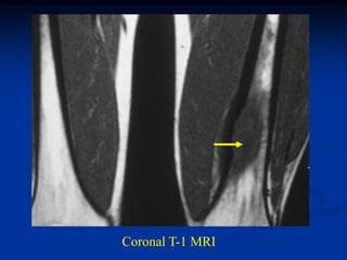 Coronal T-1 MRI
 
