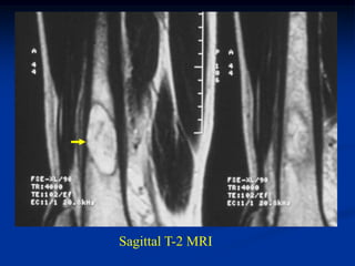 Sagittal T-2 MRI
 