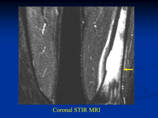 Coronal STIR MRI
 