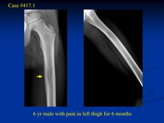 Case #417.1




          6 yr male with pain in left thigh for 6 months
 