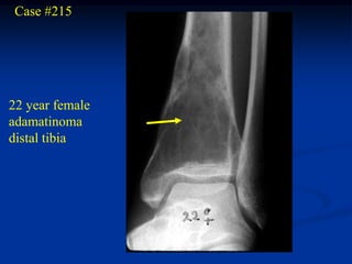 Case #215




22 year female
adamatinoma
distal tibia
 