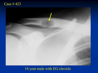 Case # 423




             14 year male with EG clavicle
 