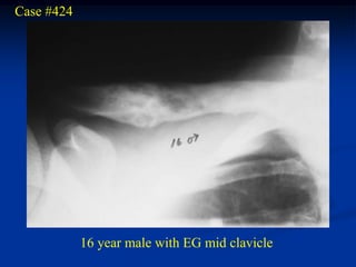 Case #424




            16 year male with EG mid clavicle
 