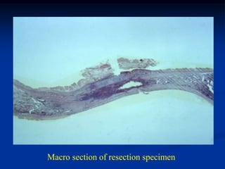 Macro section of resection specimen
 