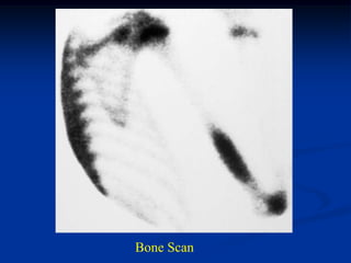 Bone Scan
 