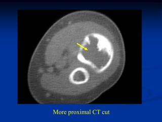 More proximal CT cut
 