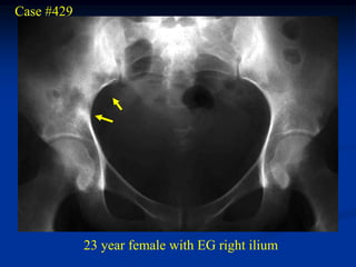 Case #429




            23 year female with EG right ilium
 