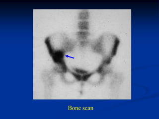 Bone scan
 