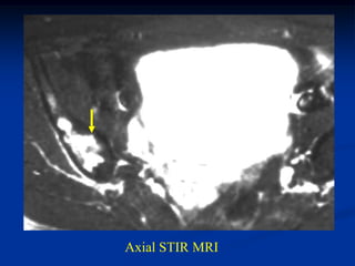 Axial STIR MRI
 