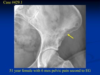 Case #429.1




   51 year female with 6 mos pelvic pain second to EG
 