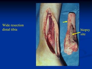 Wide resection
distal tibia     biopsy
                 site
 